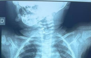 Médicos piden tener cuidado con objetos pequeños: una bebé de diez meses tragó su “primer arito”